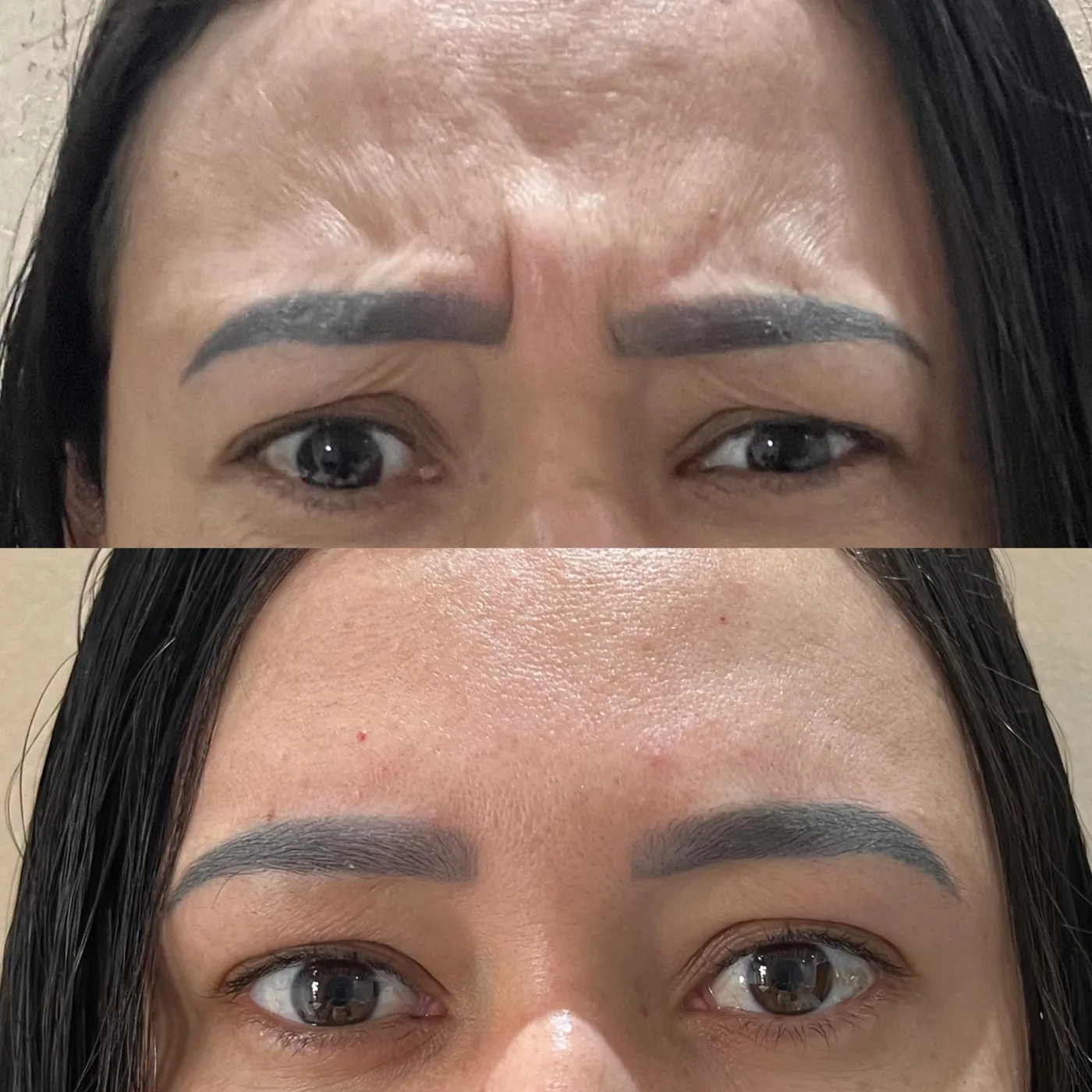 Antes e depois toxina botulínica na glabela