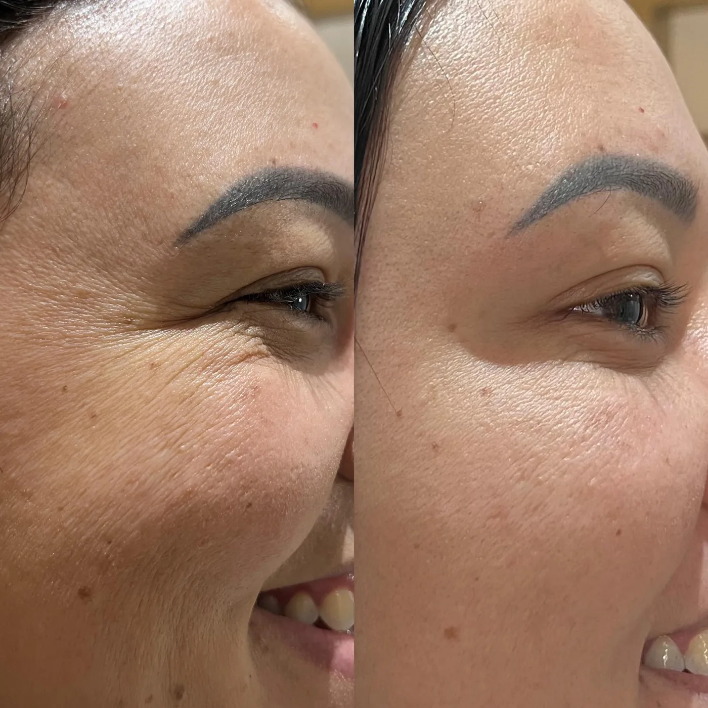 Antes e depois toxina botulínica na área dos olhos