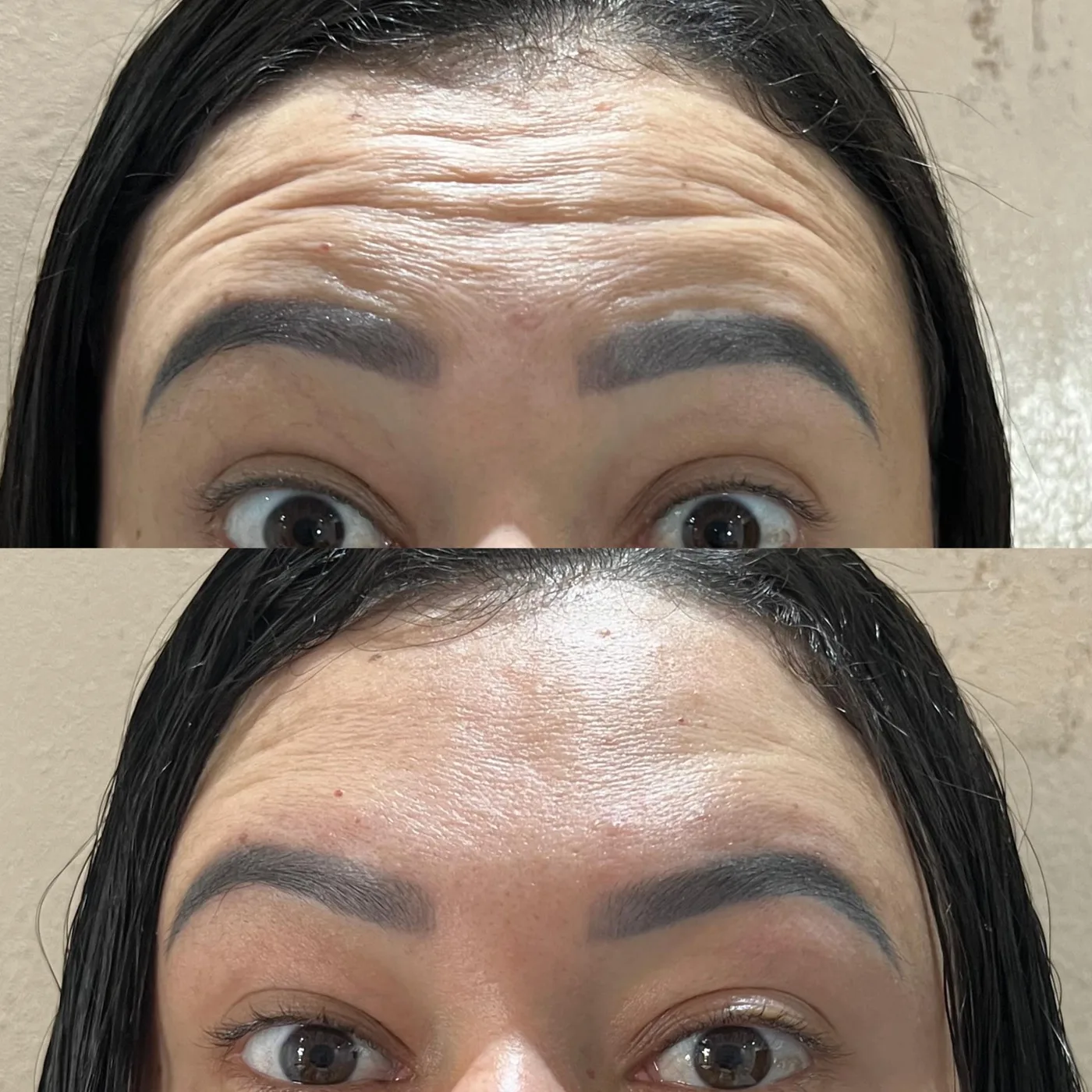 Antes e depois toxina botulínica na testa