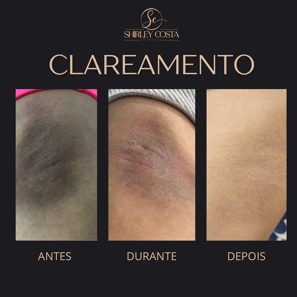 Antes e depois clareamento de axilas