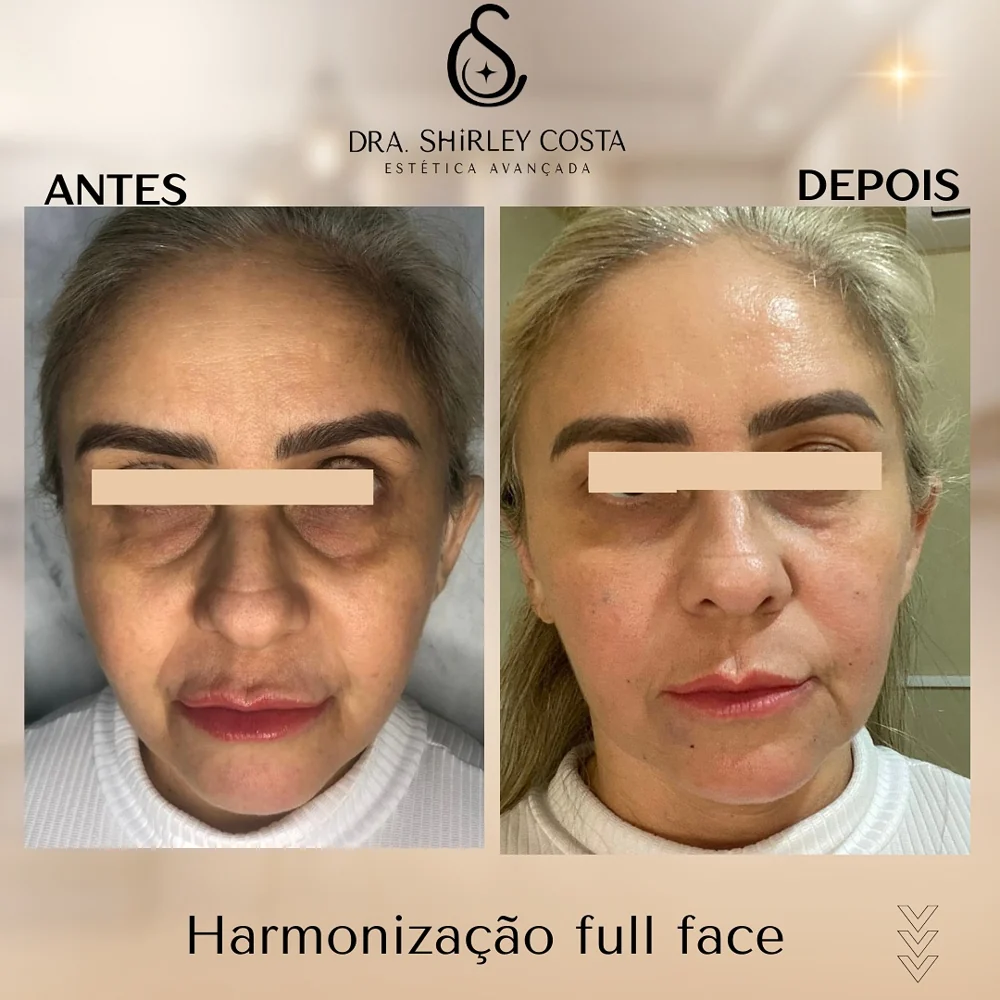 Antes e depois harmonização full face