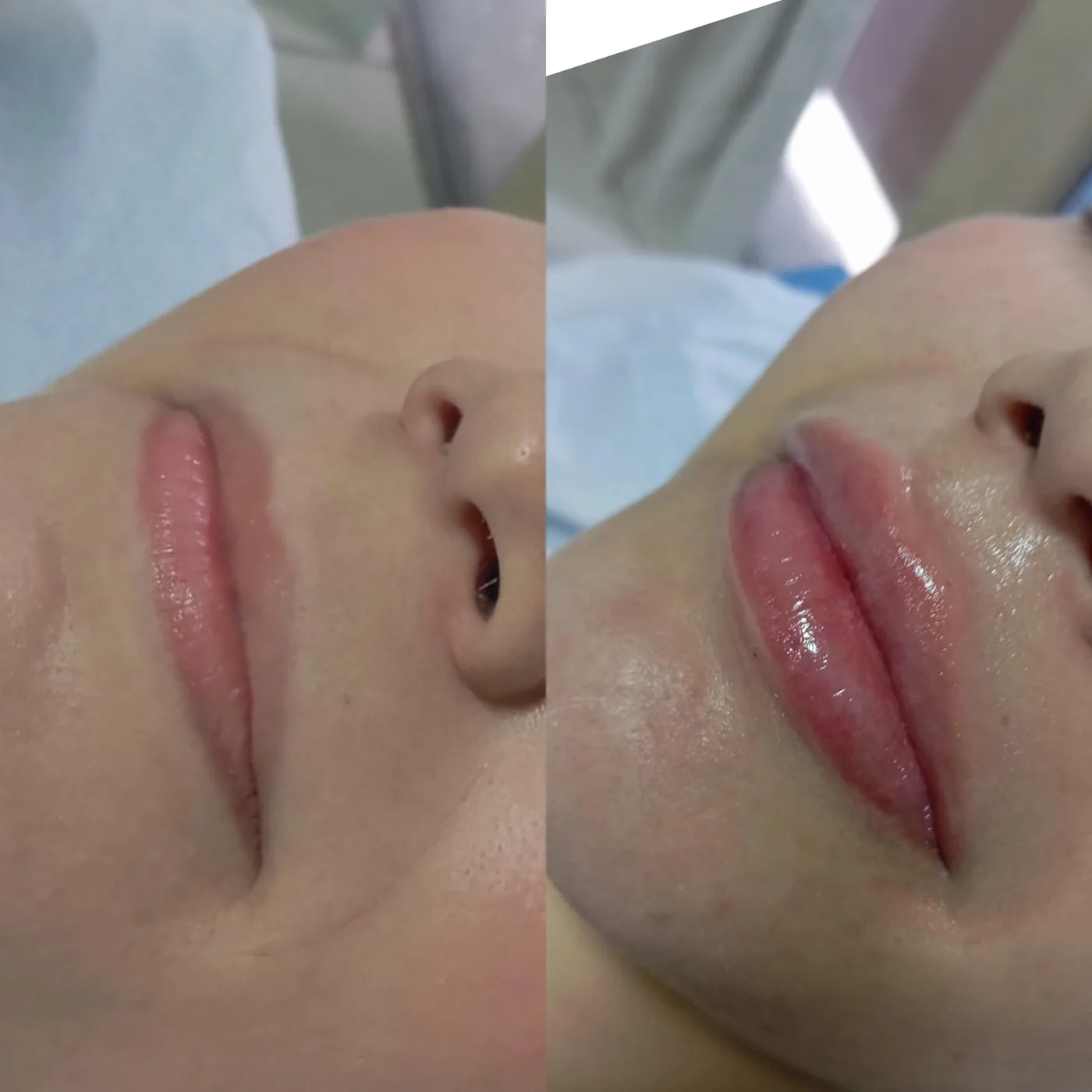 Antes e depois preenchimento labial