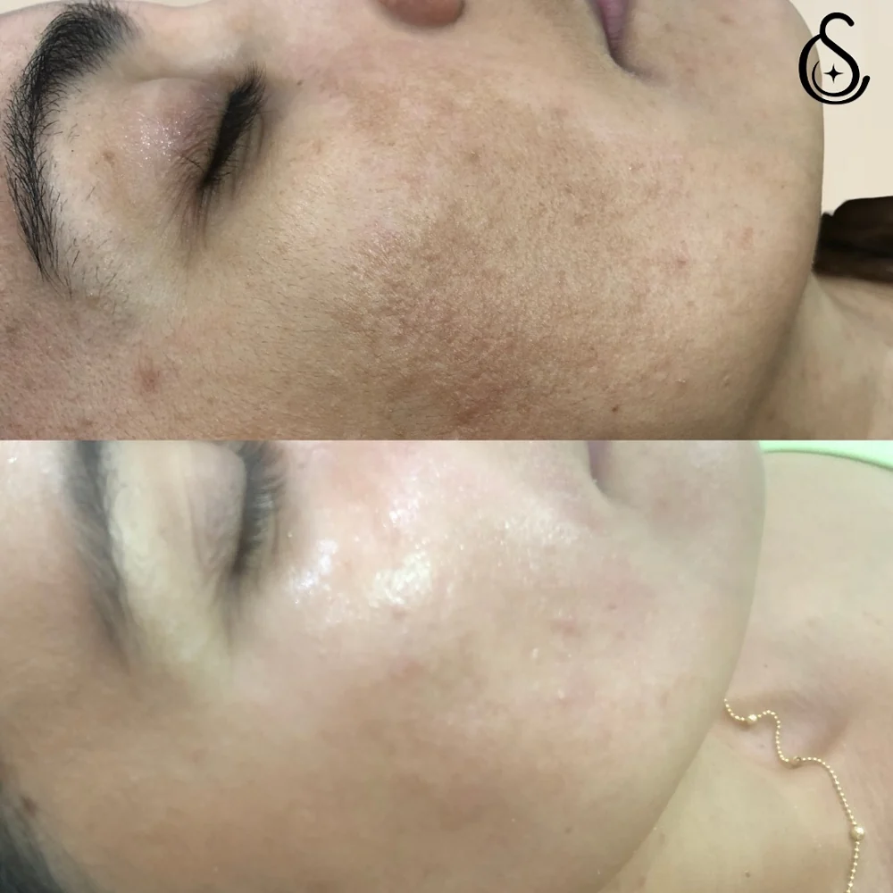 Antes e depois tratamento de melasma