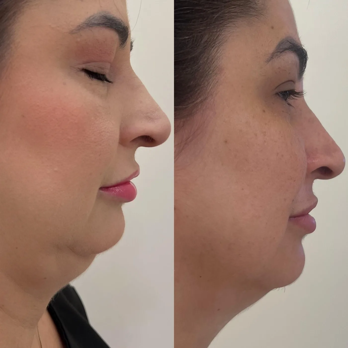Antes e depois contorno de papada