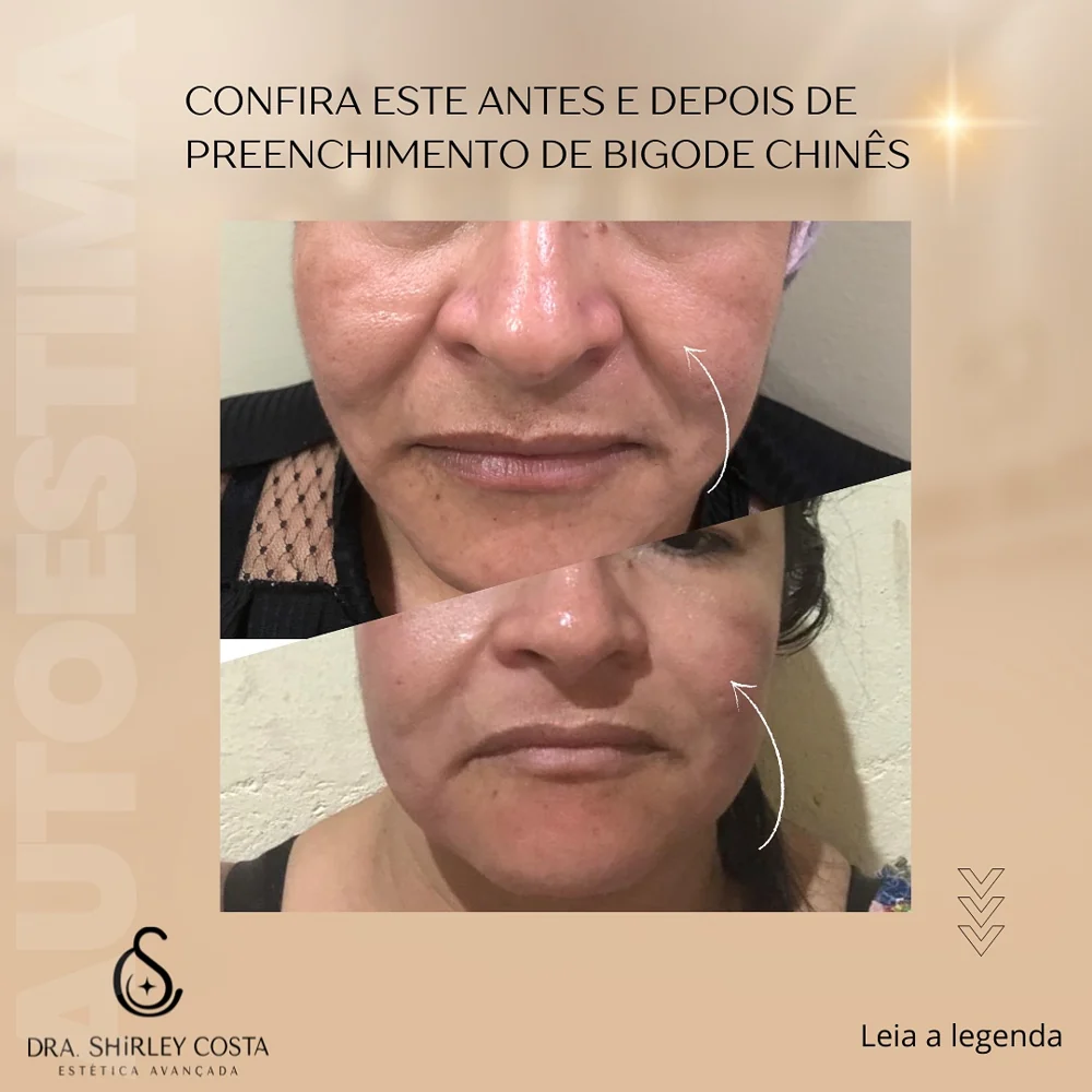 Antes e depois preenchimento